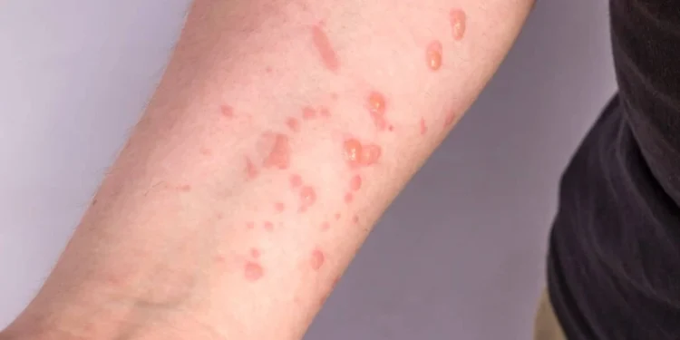 OMS aprova primeira vacina contra Mpox para uso emergencial em crianças