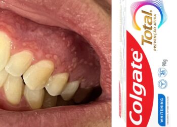 Anvisa monitora lesões e inflamações após nova fórmula de creme dental da Colgate