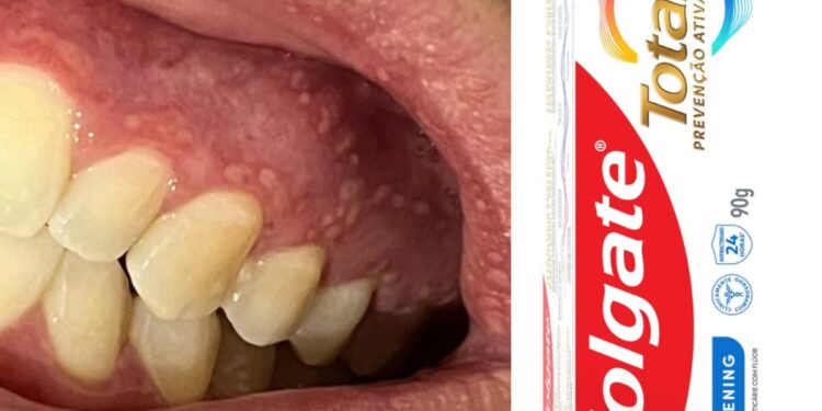 Anvisa monitora lesões e inflamações após nova fórmula de creme dental da Colgate