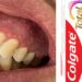 Anvisa monitora lesões e inflamações após nova fórmula de creme dental da Colgate