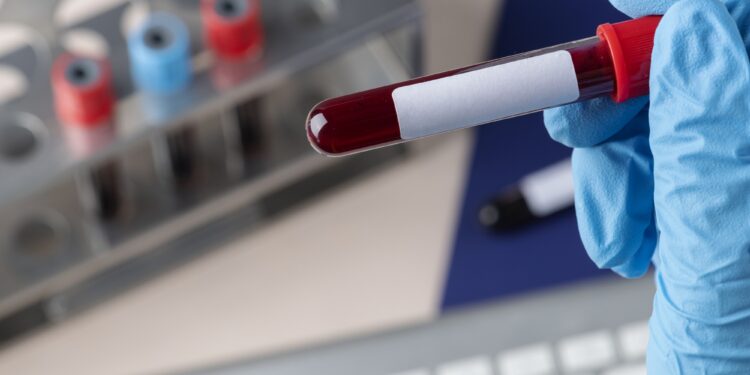 Saúde anuncia remanejamento de recursos para agilizar exames de sangue em Formiga