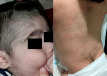 Anvisa alerta sobre relação perigosa entre bebês e minoxidil e cita ‘síndrome do lobisomem’; entenda