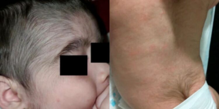 Anvisa alerta sobre relação perigosa entre bebês e minoxidil e cita ‘síndrome do lobisomem’; entenda