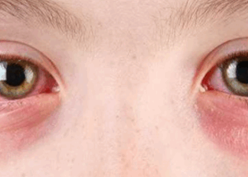 Tempo seco em Minas Gerais acende alerta para surto de conjuntivite