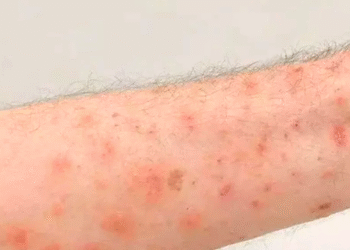 SES monitora surto de sarna humana no Centro-Oeste de Minas