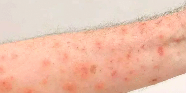 SES monitora surto de sarna humana no Centro-Oeste de Minas