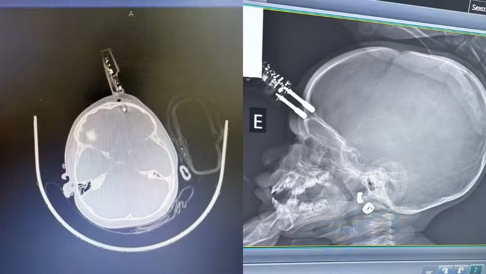 Menina de 1 ano fica com carregador cravado na testa após cair da cama em Divinópolis; imagem forte