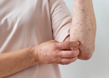 Minas soma 19 casos de Mpox em 2026; Formiga está na lista