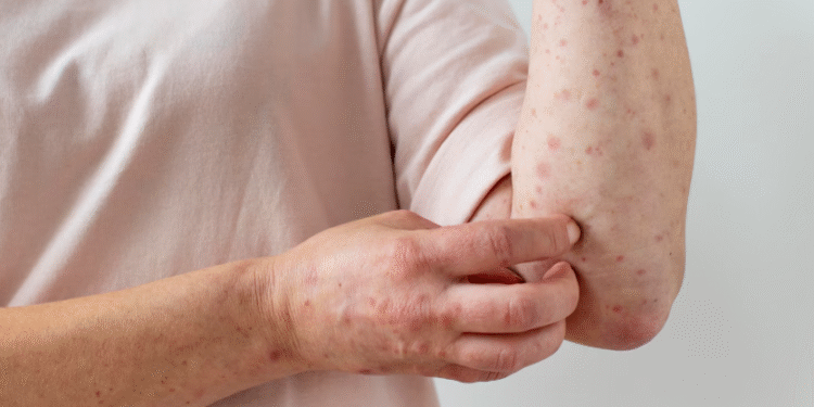 Minas soma 19 casos de Mpox em 2026; Formiga está na lista