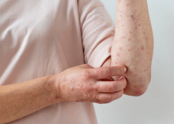 Brasil tem 140 casos confirmados de mpox em 2026, segundo Ministério da Saúde