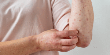 Brasil tem 140 casos confirmados de mpox em 2026, segundo Ministério da Saúde